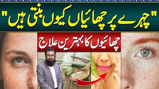 Melasma Treatment at Home  Melasma Cream and Melasma Home Remedies  Face Par Chaiyan Ka Ilaj [upl. by Carpio633]