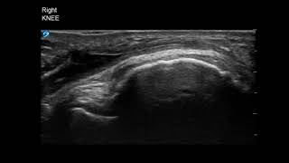 Knee Ultrasound Infrapatellar Bursitis Aspiration Part 3 [upl. by Arel515]