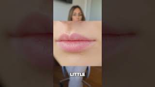 Lip Flip vs Lip Filler Whats the difference [upl. by Nyrol]