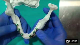 Edentulous Maxilla and Mandible Reconstruction  3D Printed Subperiosteal Implants [upl. by Nail]