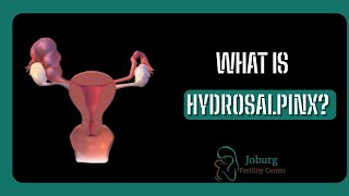 WHAT IS HYDROSALPINX [upl. by Akirej]