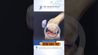 PRP treatment for KNEE pain  Dr Sharath Babu Nilagiri  prpinjection kneepainrelief prptherapy [upl. by Neened]