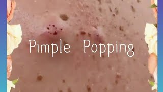 Pimple amp Blackheads Popping  39 [upl. by Kcirrag]