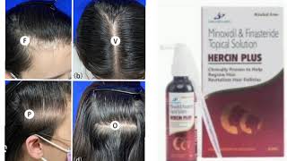 HERCIN PLUS Topical Solution Minoxidil amp Finasteride Topical Solution [upl. by Natassia670]