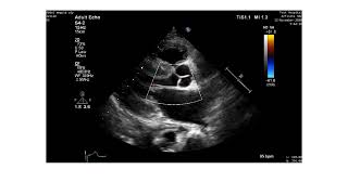 How to diagnose amyloidosis by echocardiography [upl. by Baptlsta755]