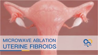 Microwave Ablation of Uterine Fibroids  Animation [upl. by Daenis]