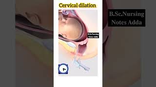 Cervical dilation procedure anatomy obg [upl. by Eynahpets789]