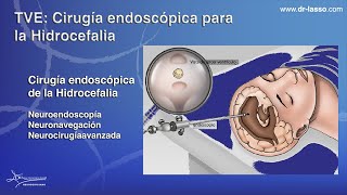 Hidrocefalia TVE cirugia endoscopica comentada [upl. by Clarie135]