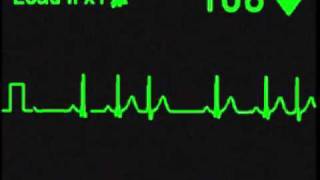 Nodal Trigeminy  ECG Simulator  Arrhythmia Simulator [upl. by Sherlock994]