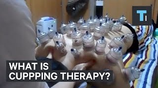 What is cupping therapy [upl. by Ichabod]