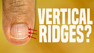 Uncovering the True Reasons Behind Vertical Ridges on Your Nails [upl. by Nyvets]