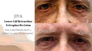 JIYA  Lower Lid Retraction Ectropian Revision via Canthoplasty  Orbicularis Tightening [upl. by Roldan]