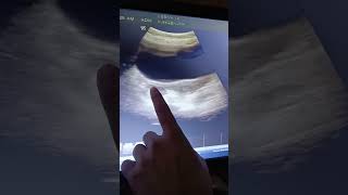 how detect ovaries in ultrasound Ultrasound me ovary kese dekhedikhti h ovary ovaries uterus [upl. by Colman]