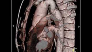 Cardiac Dilated aortic root and aortic stenosis 4 of 6 [upl. by Durham363]