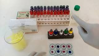 Widal Test  Typhoid test  टाइफाइड इन हिन्दी । [upl. by Eciruam282]