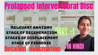 PROLAPSED INTERVERTEBRAL DISCPIVD  stages  In Hindi orthopaedic  Maheshwari [upl. by Ahsienet842]