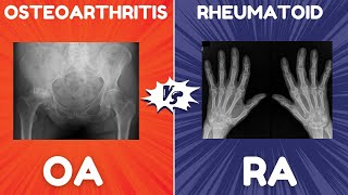 Osteoarthritis OA vs Rheumatoid Arthritis RA  Radiographic Features [upl. by Mecke856]