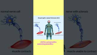 Amyotrophic lateral sclerosis neuroscience amyotrophiclateralsclerosis brainscience [upl. by Isyed347]