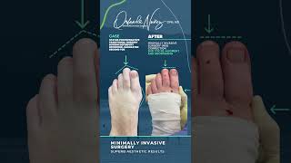 Minimally Invasive Foot Sugery  Bunion deformity Deformed elongated second toe [upl. by Ssitruc]