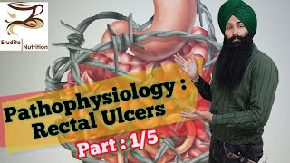 Pathophysiology of rectal Ulcers What are Rectal Ulcers Part 15 [upl. by Kirred689]