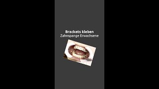 Zahnspange Erwachsene  Brackets kleben shorts [upl. by Bara]