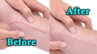 Keloid Scar Removal  Home Natural Remedies [upl. by Padgett]