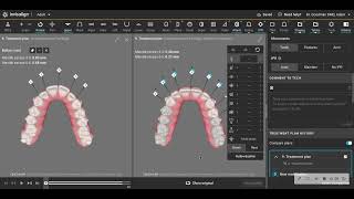 Avoid palatal root torque if you dont need it [upl. by Zebapda452]