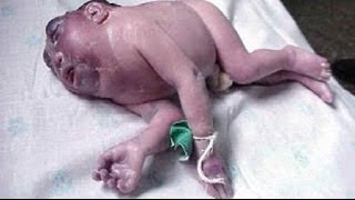 BABIES with BIRTH DEFECTS eg SMALL BRAINS due to RADIATION Research  2017 [upl. by Hait]