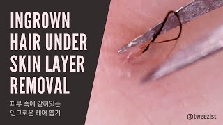 Tweezist Ingrown hair removal [upl. by Liu]