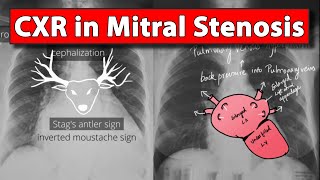 Chest Xray Part 3 in Mitral Stenosis  Made easy [upl. by Rahcir286]