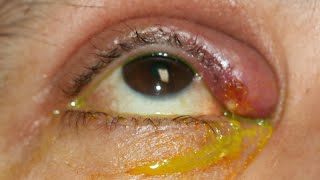 Eye lid infection condition explained indetail eyecareoptom [upl. by Olfe919]