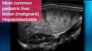 Mesenchymal Hamartoma [upl. by Supmart]