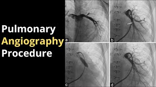 Pulmonary Angiography Procedure Angiogram Balloon Video [upl. by Anirtruc]