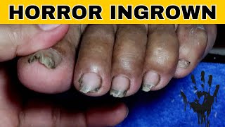 Ingrown Toenail Removal Pedicure [upl. by Boniface]