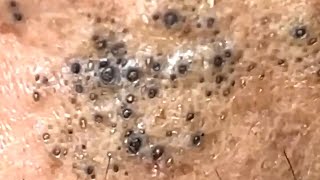 Blackheads Satisfying Removal 0003 [upl. by Adnelg635]