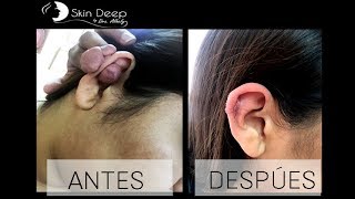 ยก CICATRIZ QUELOIDE  ANTES Y DESPUรS [upl. by Iclehc242]