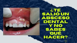 ABSCESO DENTAL ¿Qué es y cómo eliminarlo [upl. by Heisser]