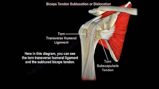 Biceps Tendon Subluxation Or Dislocation  Everything You Need To Know  Dr Nabil Ebraheim [upl. by Yajet]