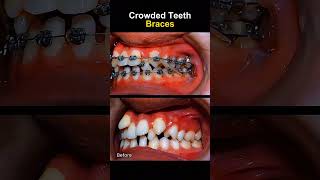 Teeth very crowded and crooked before braces braces orthodontist dentist [upl. by Rebme]