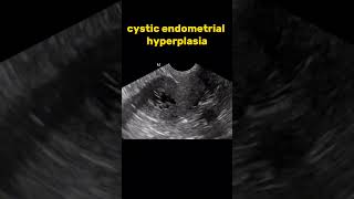 Cystic endometrial hyperplasia ultrasound radiologysonology [upl. by Defant]