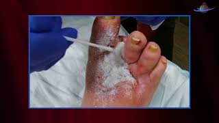 WCW Applying Altrazeal to a Post Surgical Diabetic Foot Ulcer [upl. by Meyer]