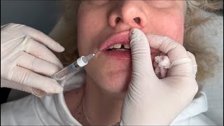 Professional Lip Filler Injection Guide Safe amp Effective Technique Explained [upl. by Alyson]