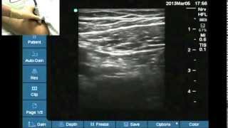 Ultrasound anatomy of the femoral nerve [upl. by Gnahk823]