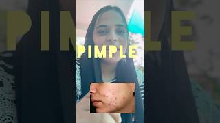 Easy Tip for Instant pimple remover pimple explore trending Mukakuru tips skincaretips [upl. by Greg]