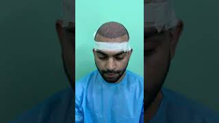 besthairtransplantresults hairgrafting hairloss highdensity viral viralvideo viralshorts [upl. by Froh]