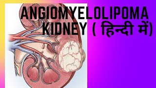 Angiomyelolipoma AML of kidney  एंजियोमायोलिपोमा एएमएल किडनी [upl. by Ramu69]