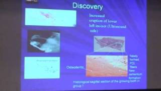 Part 1 Ultrasound Based Dental Root Repair [upl. by Bancroft]