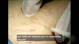 Escleroterapia Tratamiento efectivo para las varices y venas arañitas [upl. by Sugar158]