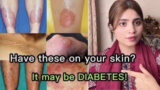 10 diabetic skin problems amp Top signs of diabetes on the skin [upl. by Platt]