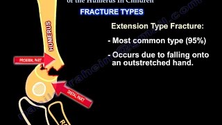 Supracondylar Fractures Of The Humerus In Children [upl. by Arihas219]